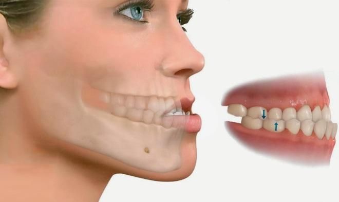 Hô Hàm Dưới Là Gì Nguyên Nhân Và Cách Điều Trị Hiệu Quả