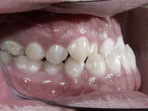Hô Hàm Dưới Là Gì Nguyên Nhân Và Cách Điều Trị Hiệu Quả