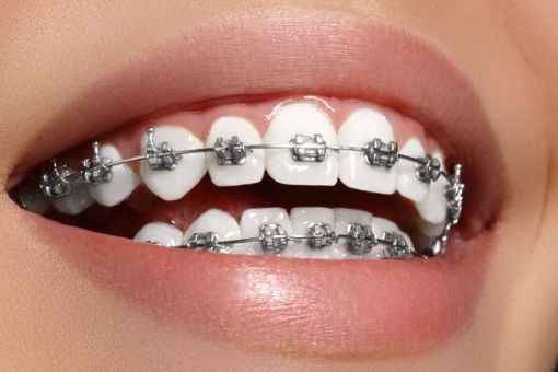 Hô Hàm Dưới Là Gì Nguyên Nhân Và Cách Điều Trị Hiệu Quả