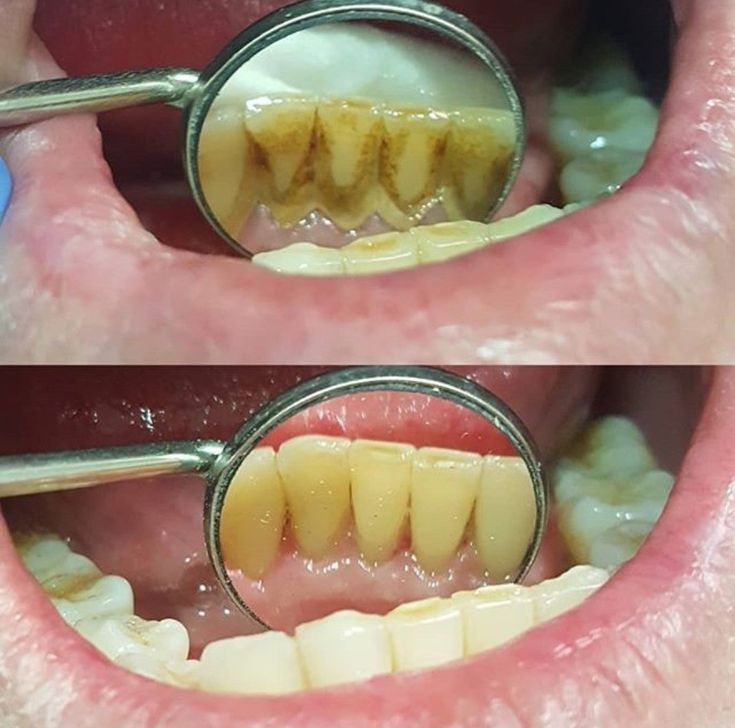 Khám Răng định Kỳ