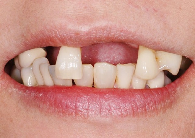 Mất Răng Lâu Năm Liệu Có Khiến Bạn Già Đi Nhanh Hơn