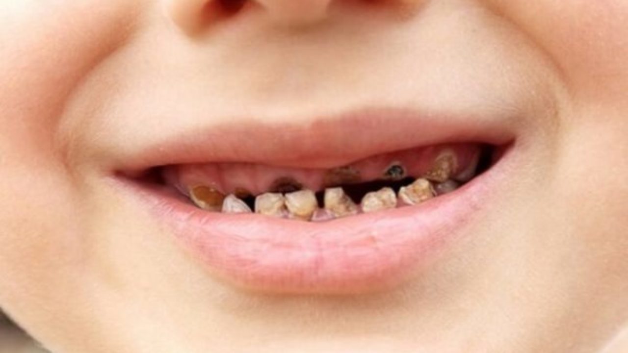 Nguyên Nhân Và Cách Phòng Ngừa Nhiễm Fluor Ở Trẻ – Cha Mẹ Cần Biết Sớm! (2)