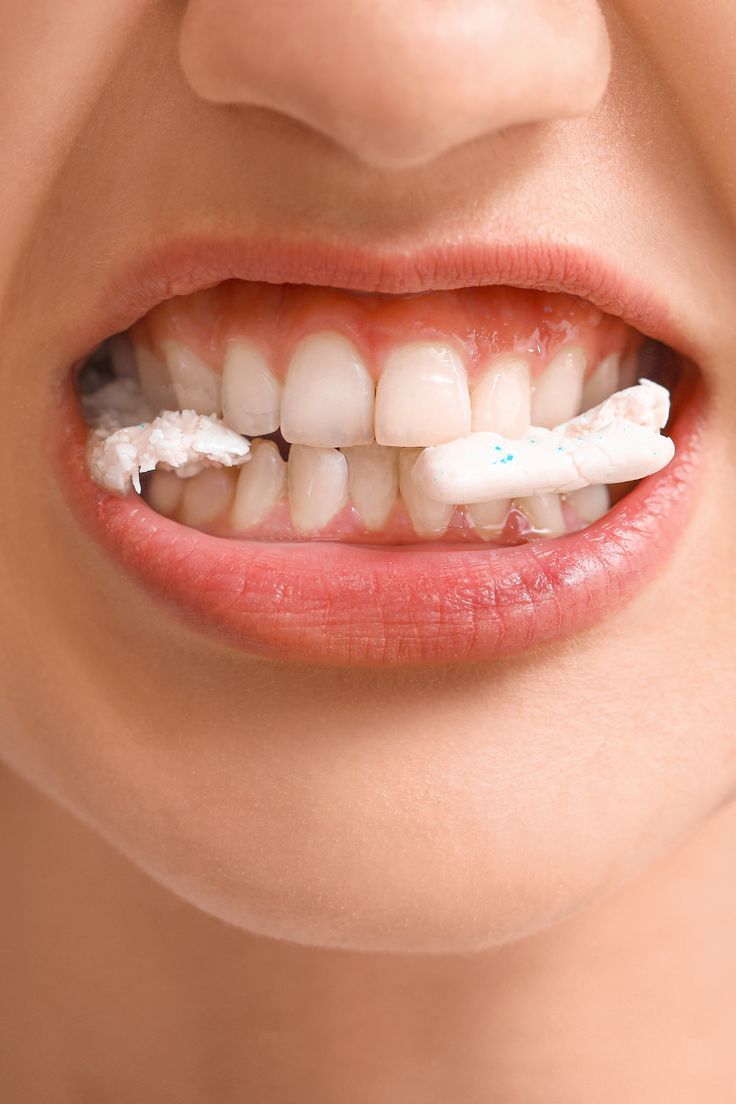Niềng Răng Bị Hóp Má Không Nguyên Nhân Và Cách Khắc Phục