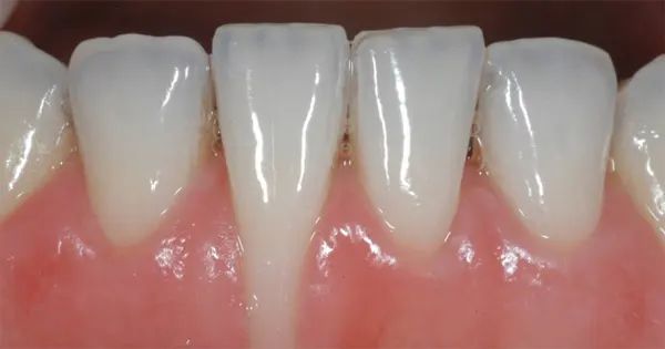 Niềng Răng Bị Hóp Má Không Nguyên Nhân Và Cách Khắc Phục
