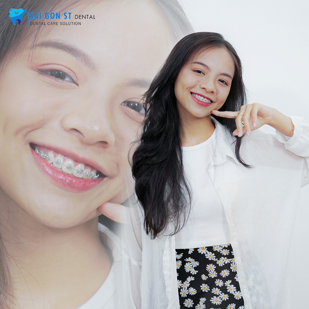Niềng Răng Bị Hóp Má Không Nguyên Nhân Và Cách Khắc Phục
