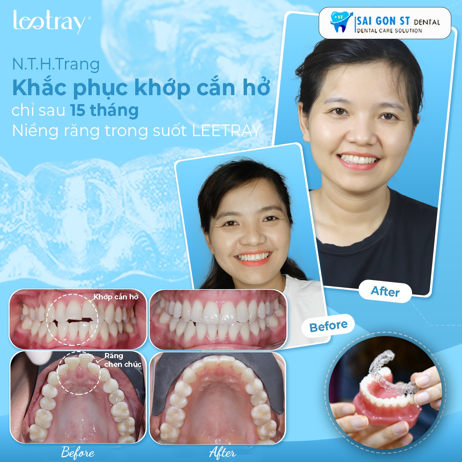 Niềng Răng Trong Suốt Invisalign