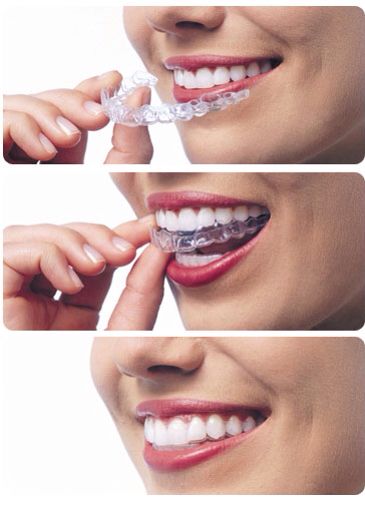 Niềng Răng Trong Suốt Invisalign