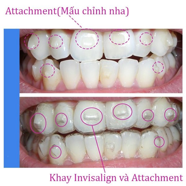 Nút Attachment Là Gì Tại Sao Phải Gắn Attachment Khi Niềng Răng Invisalign (1)