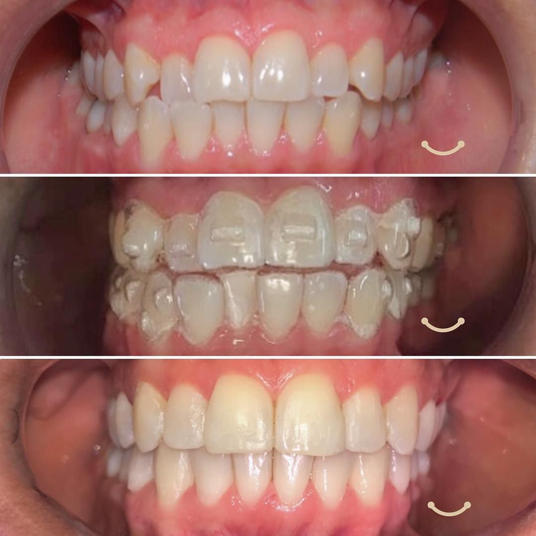 Nút Attachment Là Gì Tại Sao Phải Gắn Attachment Khi Niềng Răng Invisalign (2)