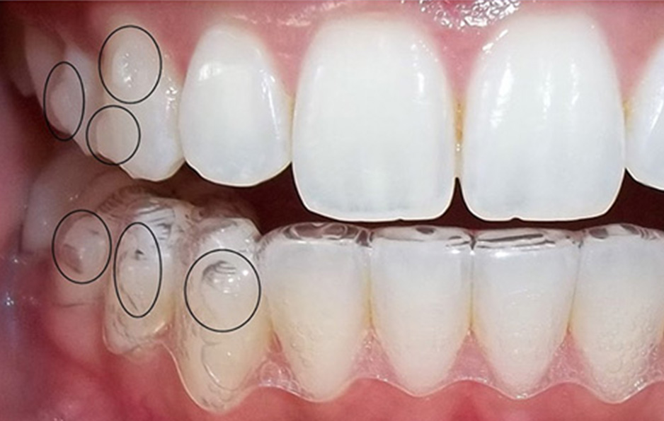 Nút Attachment Là Gì Tại Sao Phải Gắn Attachment Khi Niềng Răng Invisalign (3)