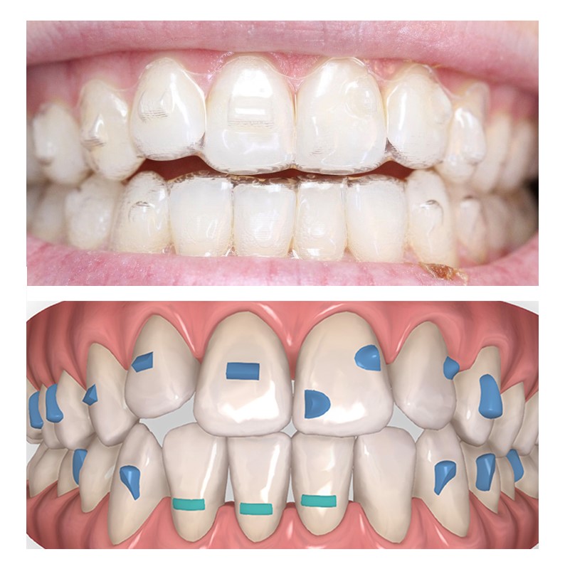 Nút Attachment Là Gì Tại Sao Phải Gắn Attachment Khi Niềng Răng Invisalign (4)