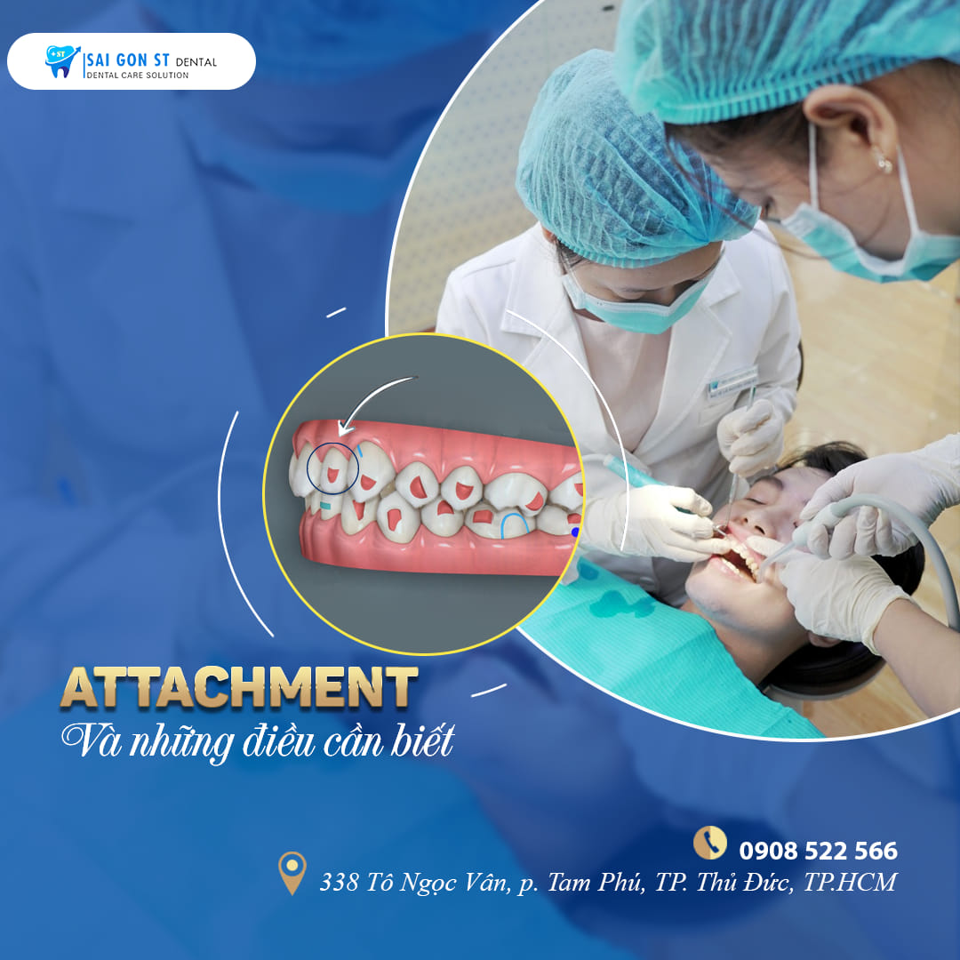 Nút Attachment Là Gì Tại Sao Phải Gắn Attachment Khi Niềng Răng Invisalign (7)