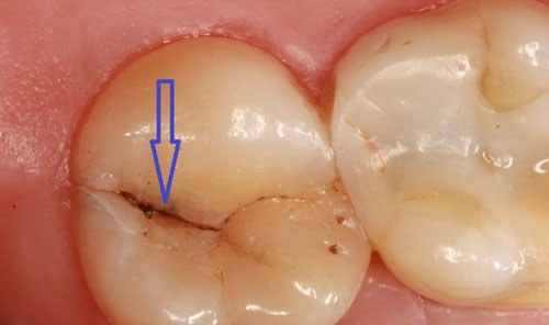 Răng Bị Nứt Có Nguy Hiểm Không Dấu Hiệu, Nguyên Nhân Và Cách Điều Trị (1)