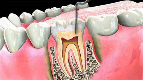 Răng Bị Nứt Có Nguy Hiểm Không Dấu Hiệu, Nguyên Nhân Và Cách Điều Trị (11)