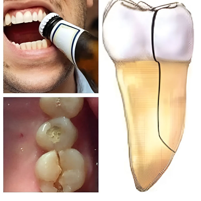 Dùng Răng Mở đồ Vật Rất Dễ Gây Nứt Gãy Răng
