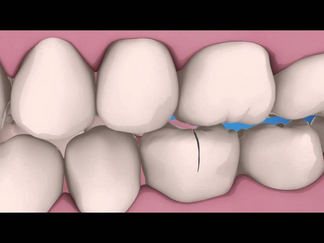 Răng Bị Nứt Có Nguy Hiểm Không Dấu Hiệu, Nguyên Nhân Và Cách Điều Trị (5)