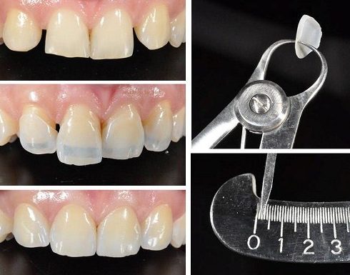 Răng Bị Nứt Có Nguy Hiểm Không Dấu Hiệu, Nguyên Nhân Và Cách Điều Trị (9)