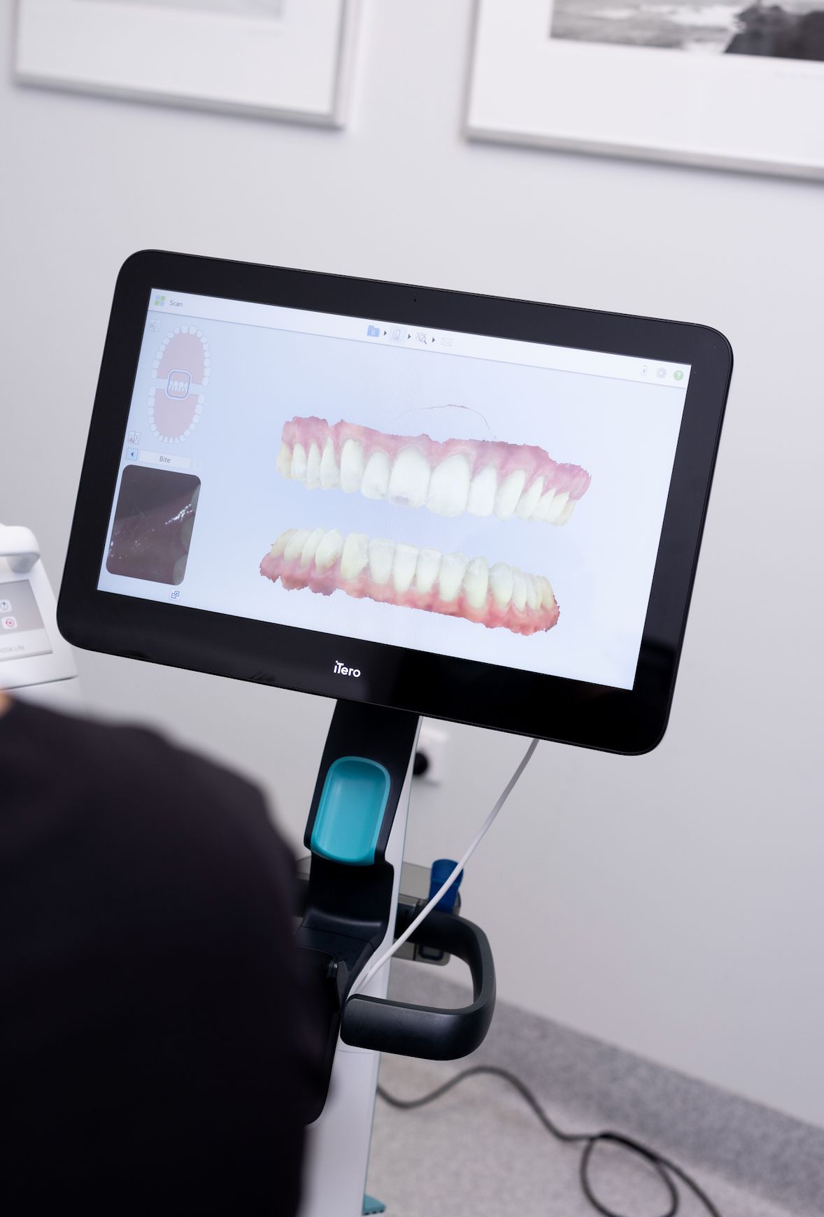 Scan RĂng 3d Khi ChỈnh Nha LÀ GÌ Quy TrÌnh Scan RĂng 3d Ra Sao