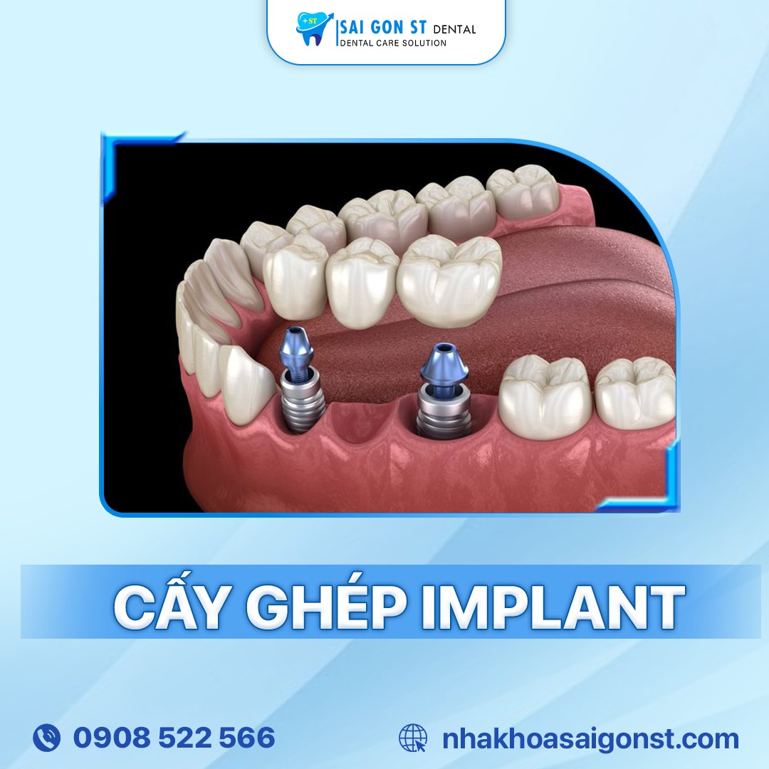 Tại Sao Nên Trồng Răng Implant Sớm Khi Bị Mất Răng
