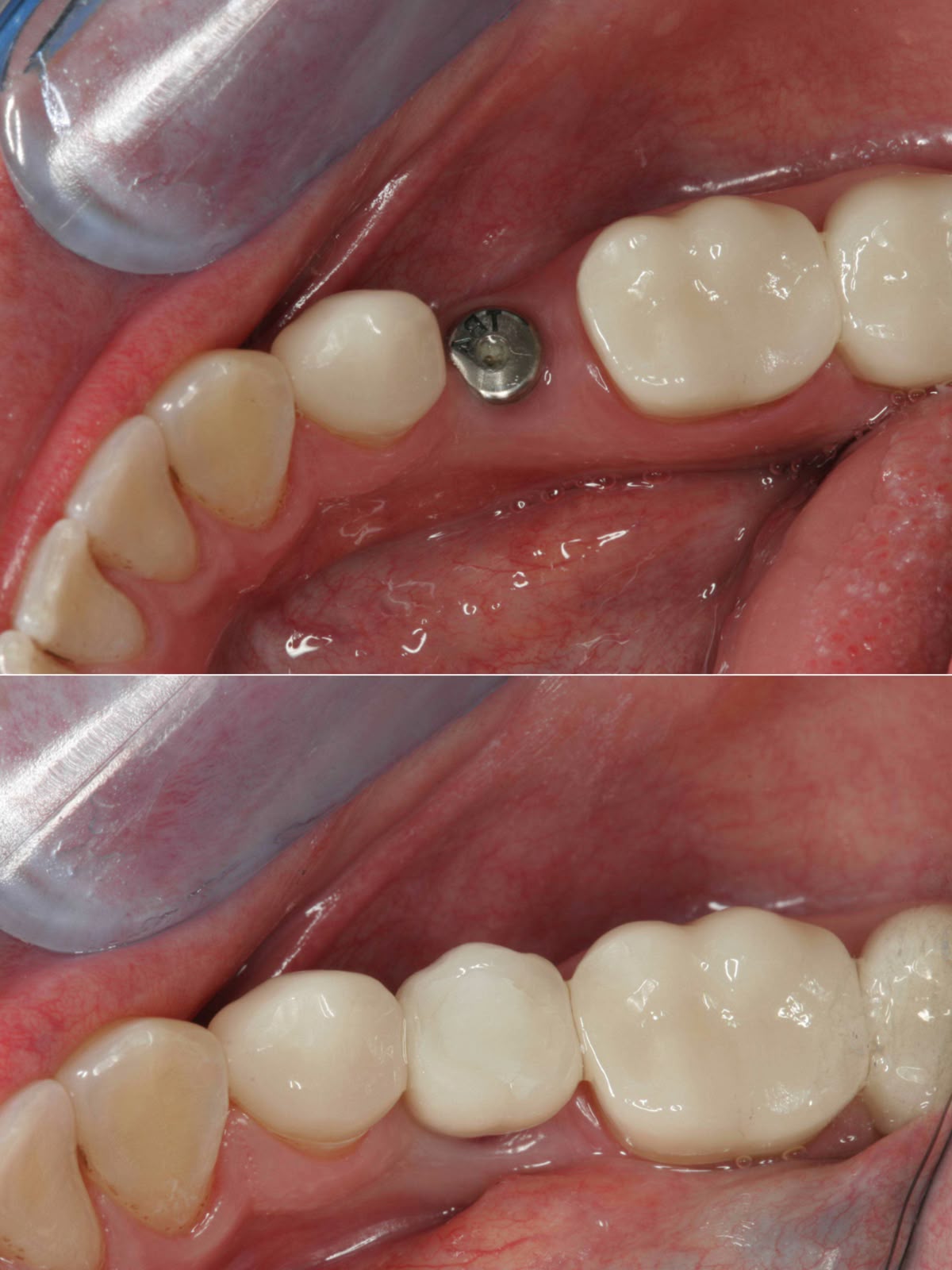 Tại Sao Nên Trồng Răng Implant Sớm Khi Bị Mất Răng