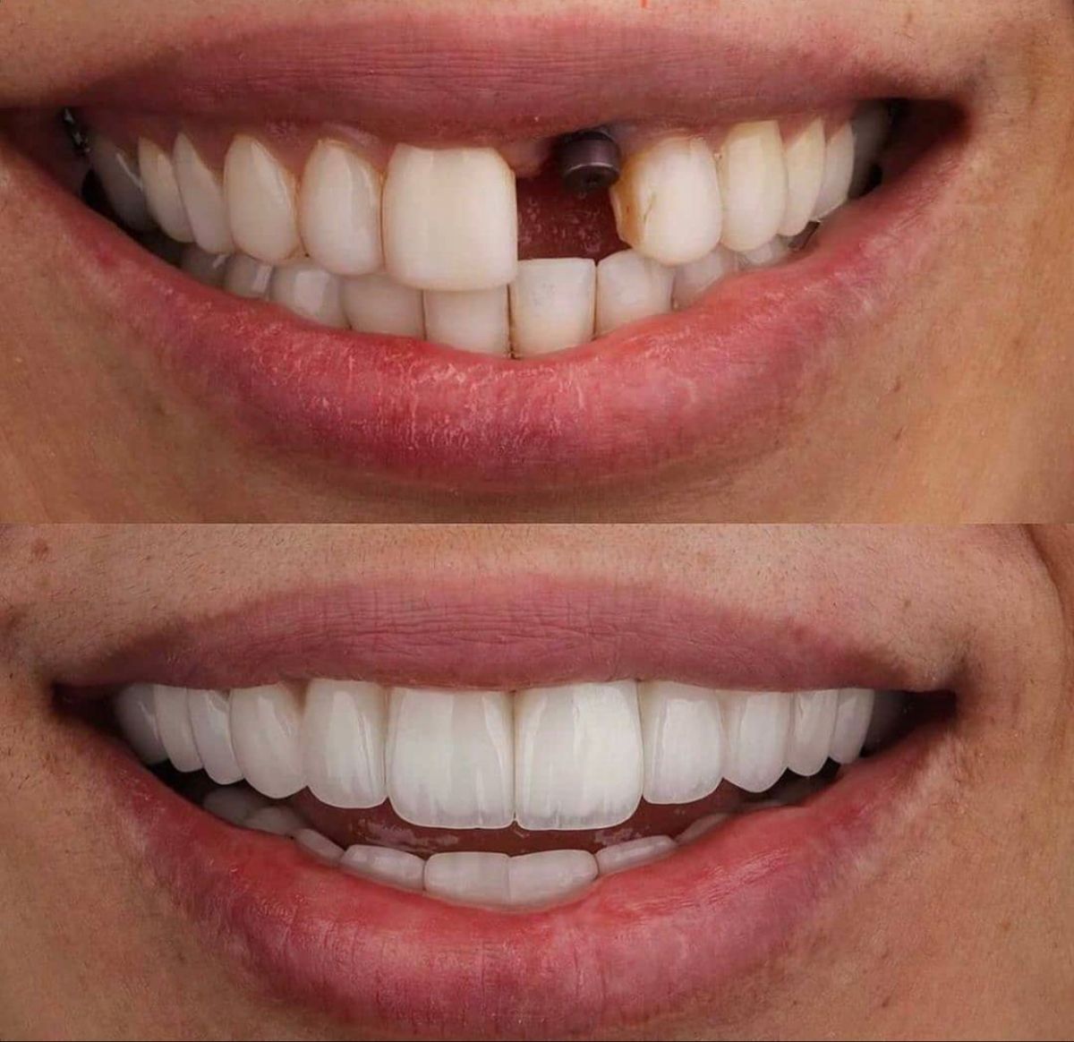 Tại Sao Nên Trồng Răng Implant Sớm Khi Bị Mất Răng