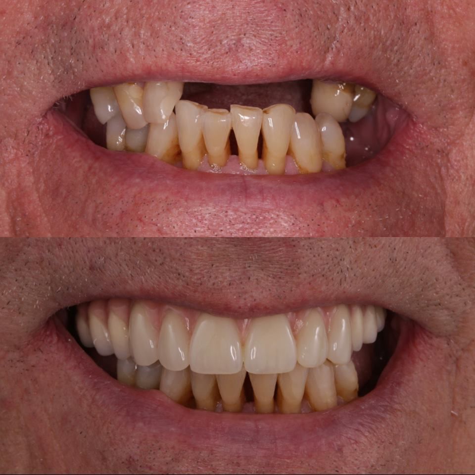 Tại Sao Nên Trồng Răng Implant Sớm Khi Bị Mất Răng