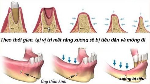 Tiêu Xương Hàm Là Gì Nguyên Nhân Và Giải Pháp Ngăn Ngừa