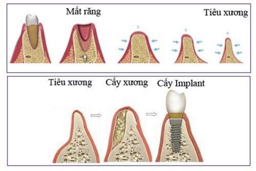 Tiêu Xương Hàm Là Gì Nguyên Nhân Và Giải Pháp Ngăn Ngừa