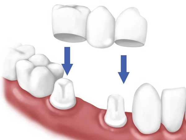 Tìm Hiểu 3 Giải Pháp Thay Thế Răng Mất Phổ Biến Hiện Nay