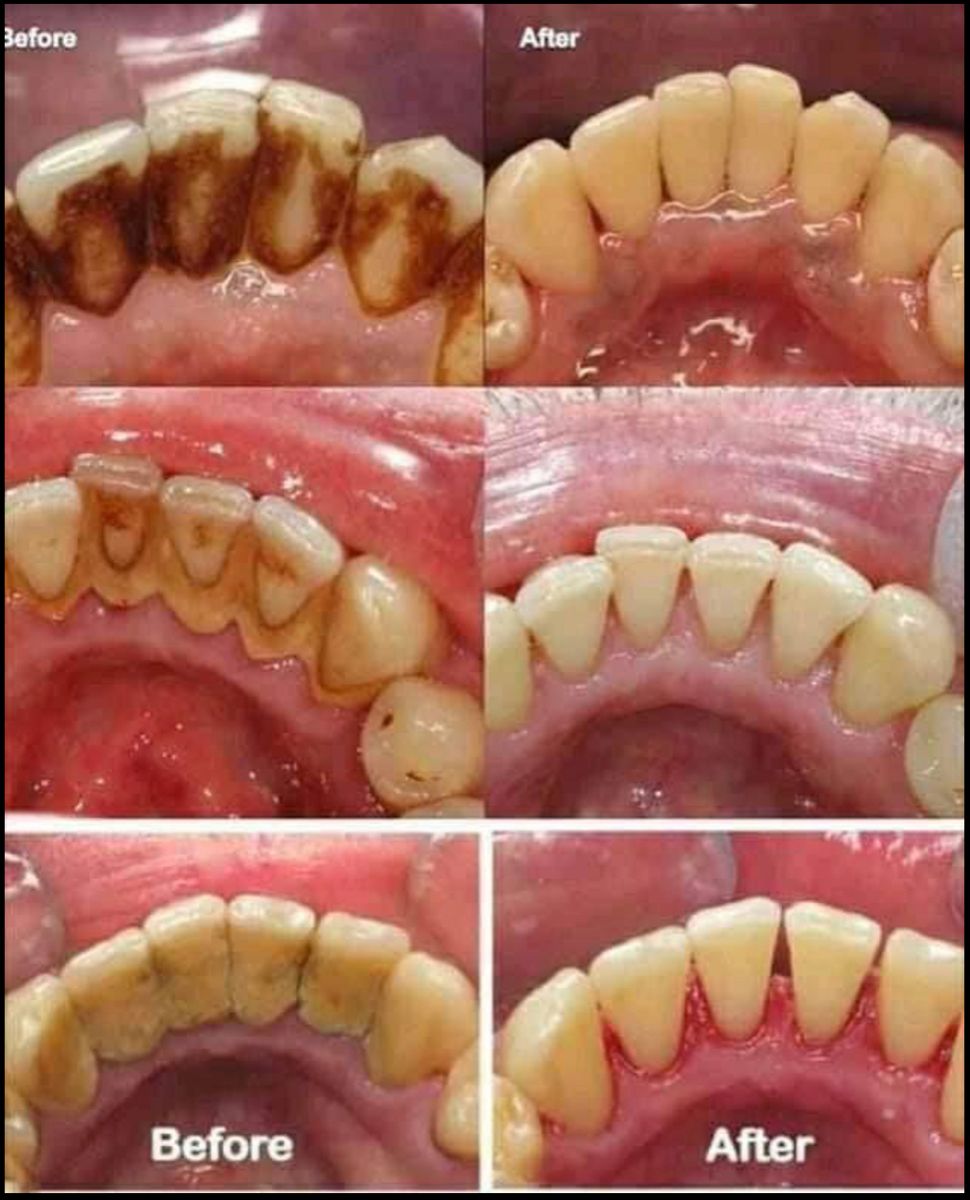 Vì Sao Nên Cạo Vôi Răng Định Kỳ