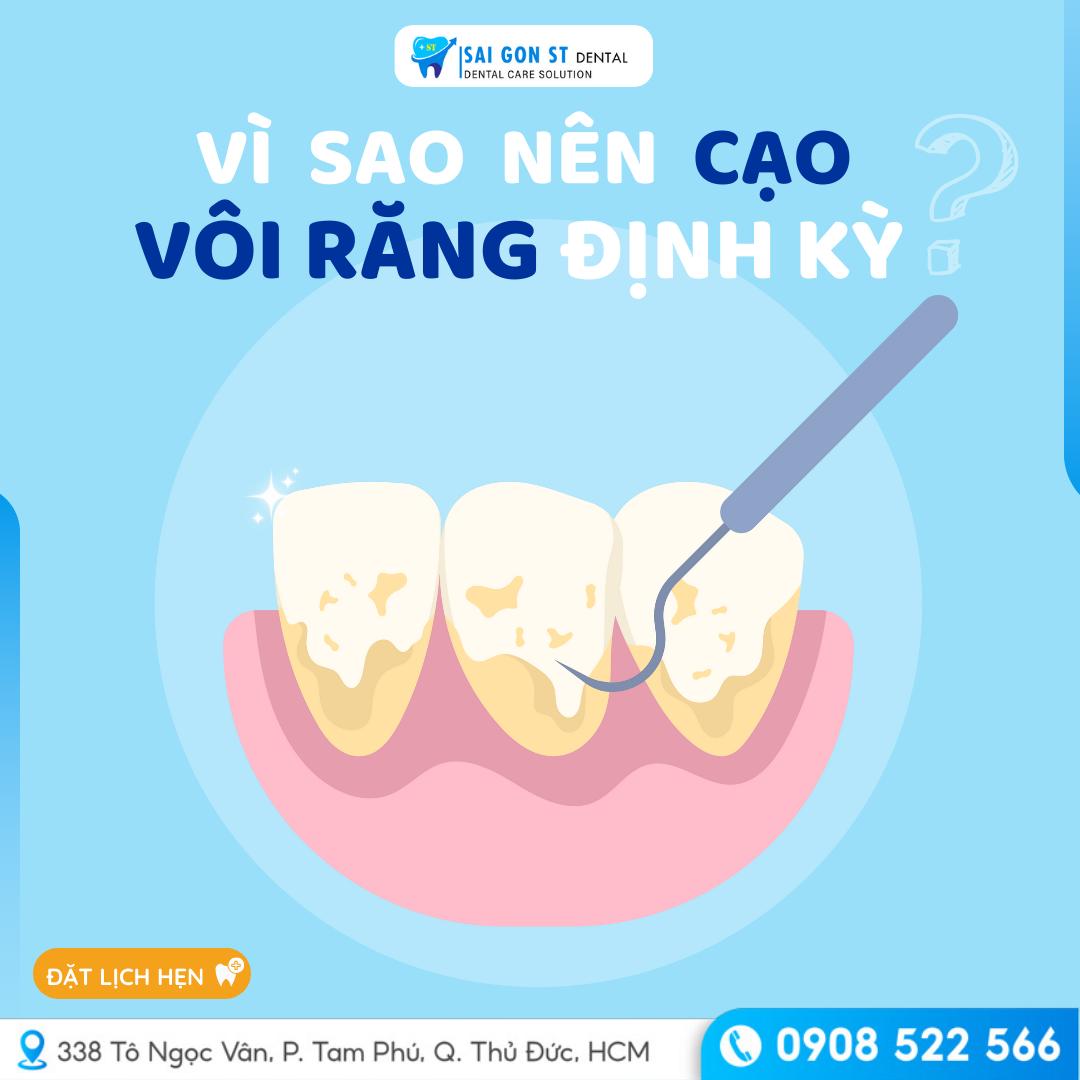 Vì Sao Nên Cạo Vôi Răng Định Kỳ