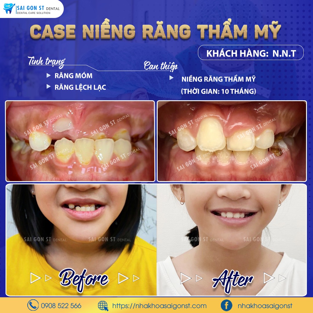 4 Lợi Ích Của Việc Niềng Răng Sớm Cho Trẻ (1)