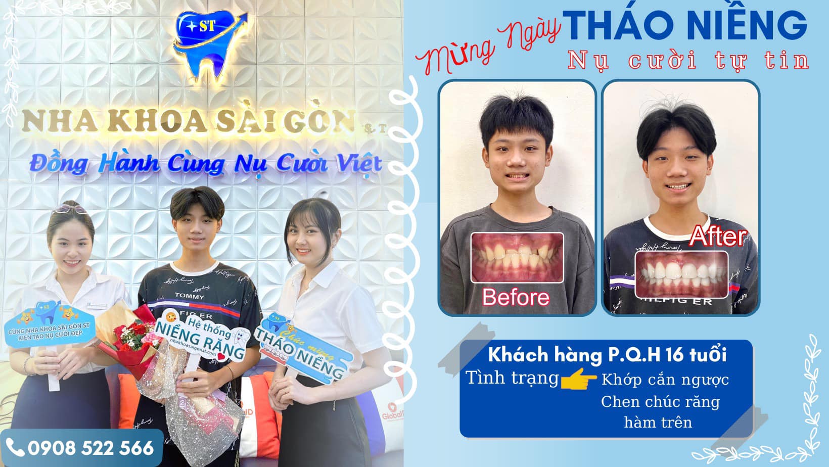 4 Lợi Ích Của Việc Niềng Răng Sớm Cho Trẻ (3)