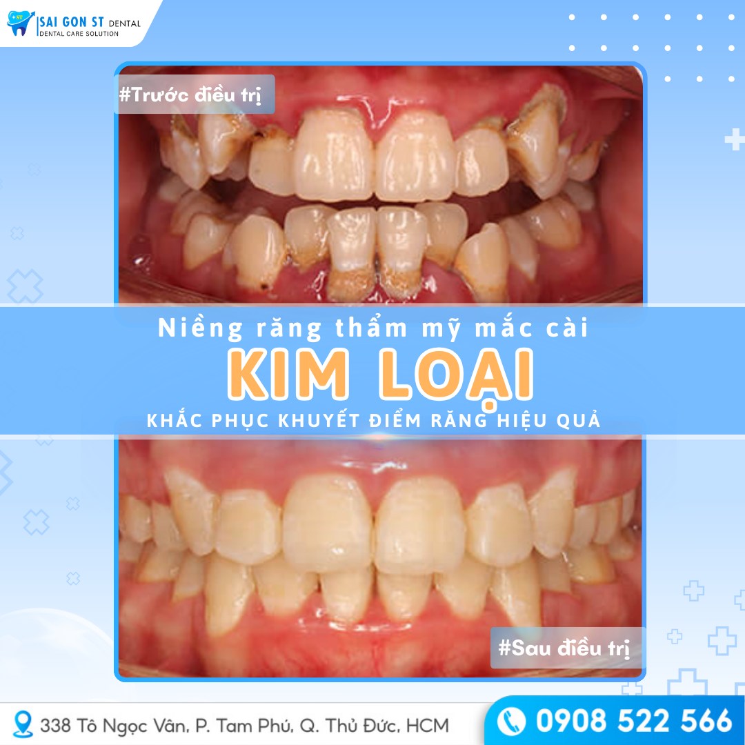 4 Lợi Ích Của Việc Niềng Răng Sớm Cho Trẻ (6)
