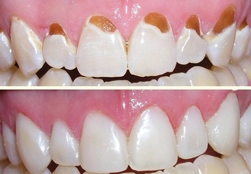 Mòn Cổ Chân Răng Là Gì (2)