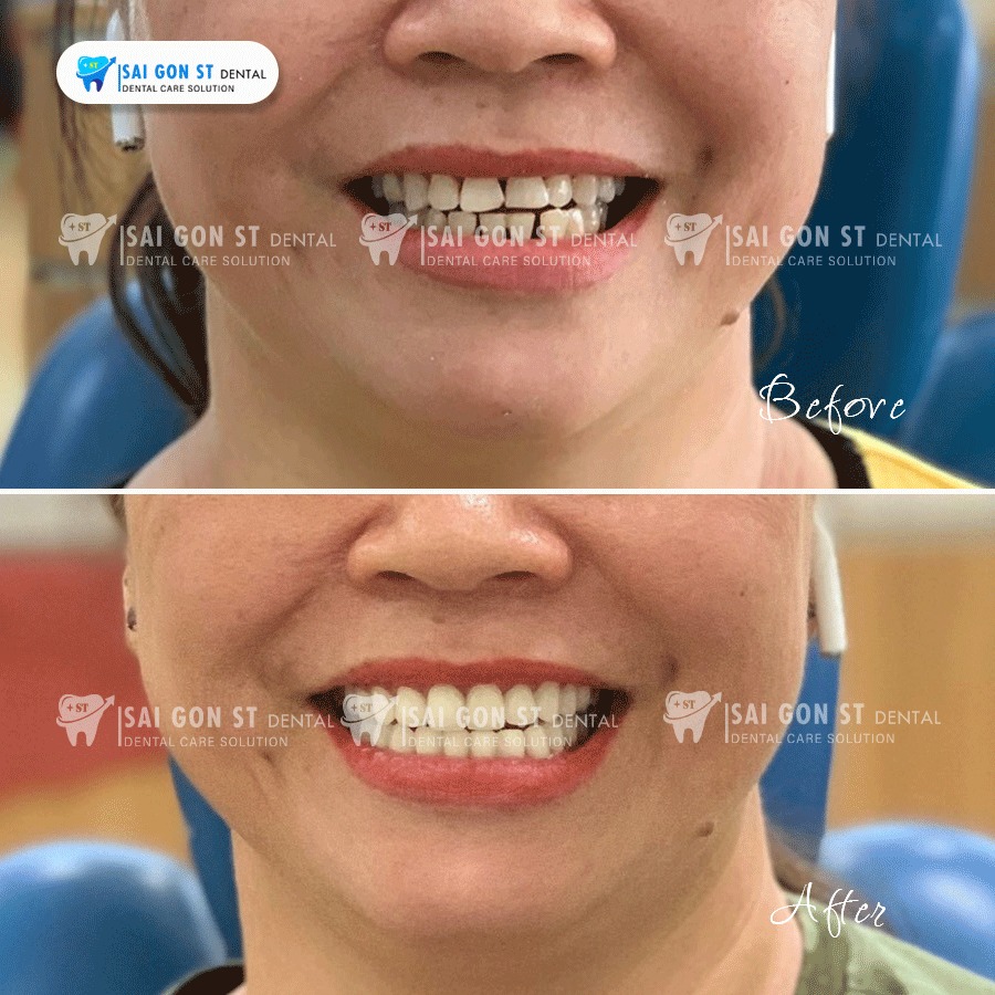 Top 4 Loại Răng Sứ Được Ưa Chuộng Nhất Hiện Nay