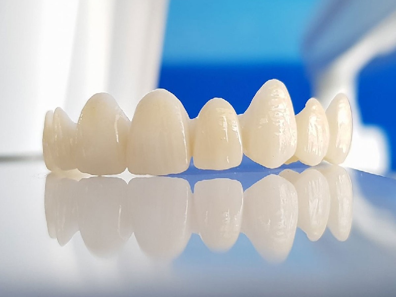 Top 4 Loại Răng Sứ Được Ưa Chuộng Nhất Hiện Nay