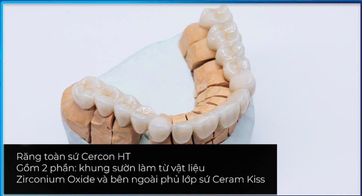 Top 4 Loại Răng Sứ Được Ưa Chuộng Nhất Hiện Nay