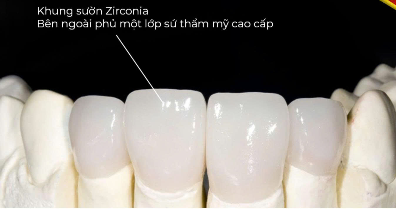 Top 4 Loại Răng Sứ Được Ưa Chuộng Nhất Hiện Nay