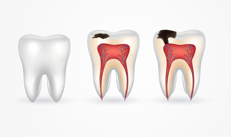 Dấu Hiệu Nhận Biết Răng Hư Tổn Và Phương Pháp Điều Trị