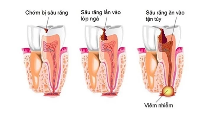 Áp Xe Răng Nguyên Nhân, Dấu Hiệu Và Cách Điều Trị (1)