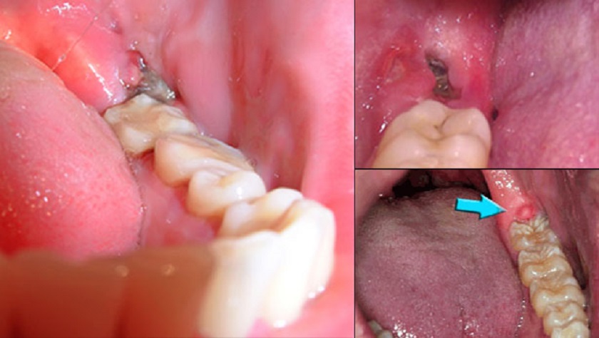 Áp Xe Răng Nguyên Nhân, Dấu Hiệu Và Cách Điều Trị