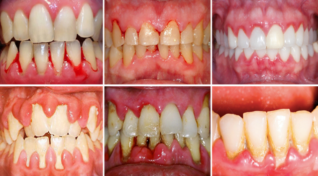 Áp Xe Răng Nguyên Nhân, Dấu Hiệu Và Cách Điều Trị (3)