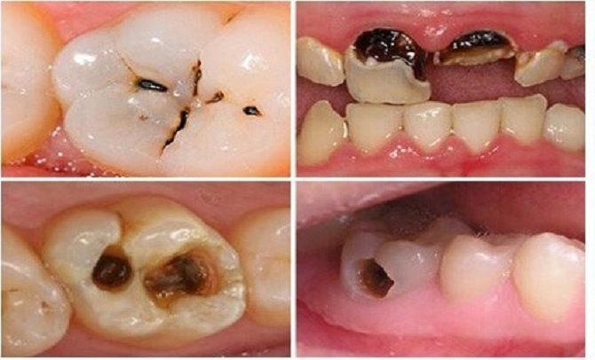 Áp Xe Răng Nguyên Nhân, Dấu Hiệu Và Cách Điều Trị