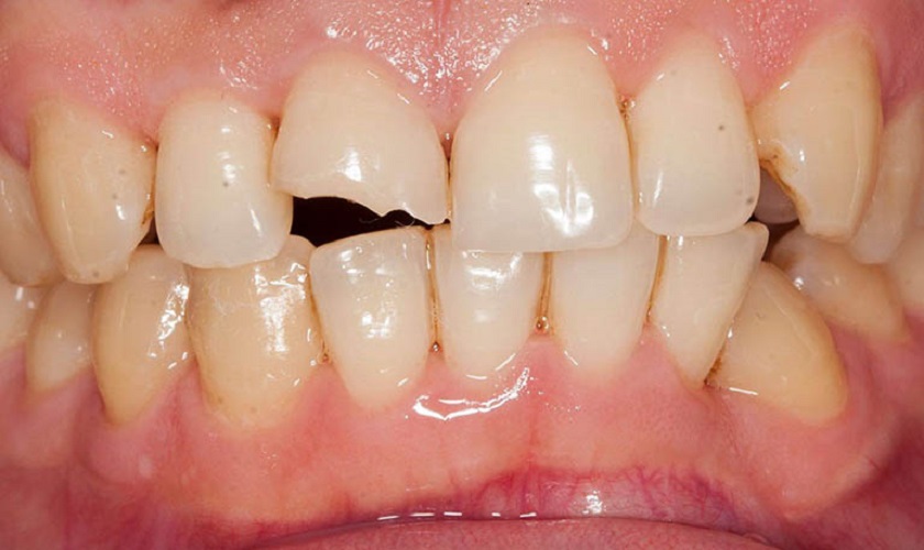 Áp Xe Răng Nguyên Nhân, Dấu Hiệu Và Cách Điều Trị