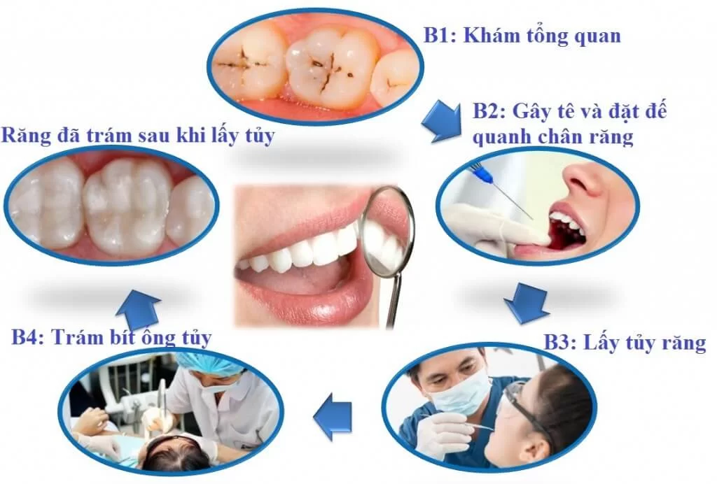 Điều Trị Tủy Răng Là Gì Quy Trình & Khi Nào Cần Điều Trị Tủy Răng (1)