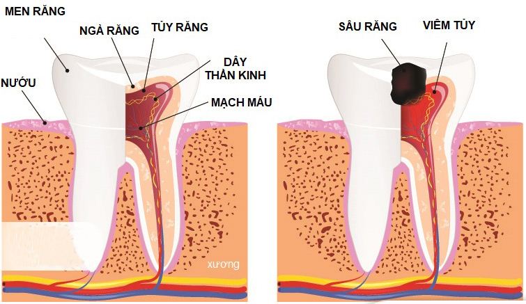 Điều Trị Tủy Răng Là Gì Quy Trình & Khi Nào Cần Điều Trị Tủy Răng (3)