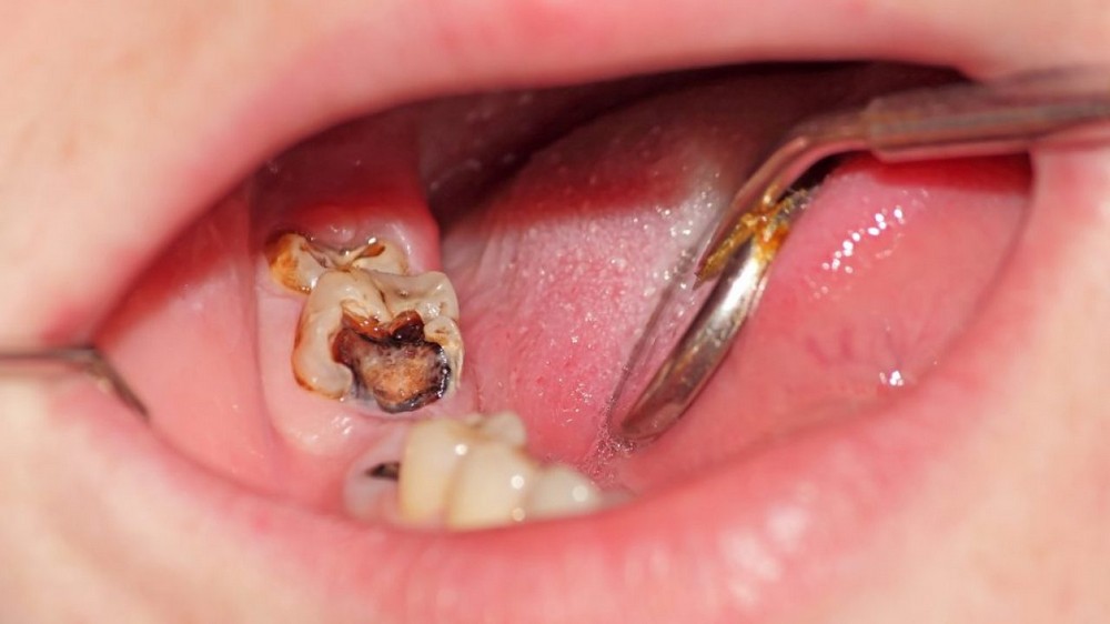 Điều Trị Tủy Răng Là Gì Quy Trình & Khi Nào Cần Điều Trị Tủy Răng (8)