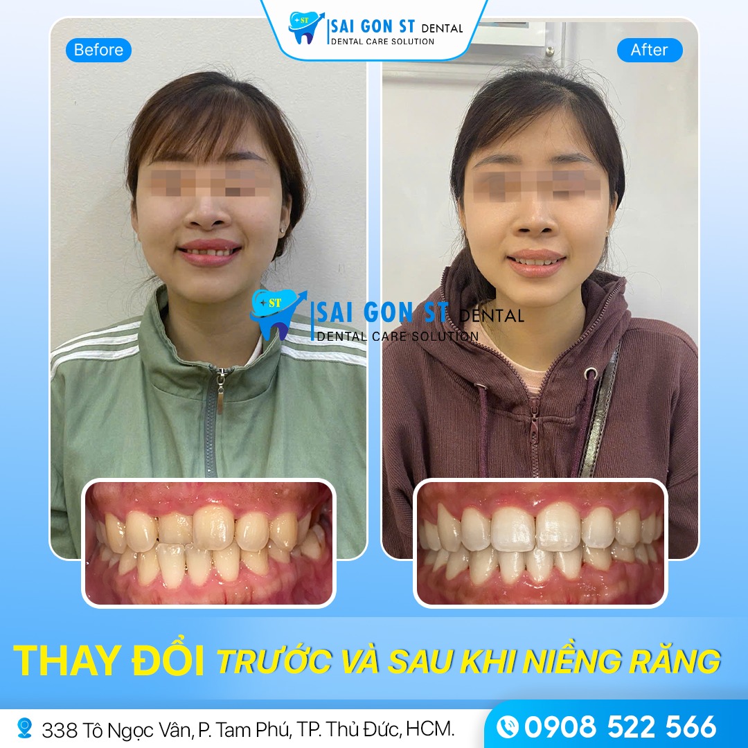 Niềng Răng Trả Góp Thủ Đức