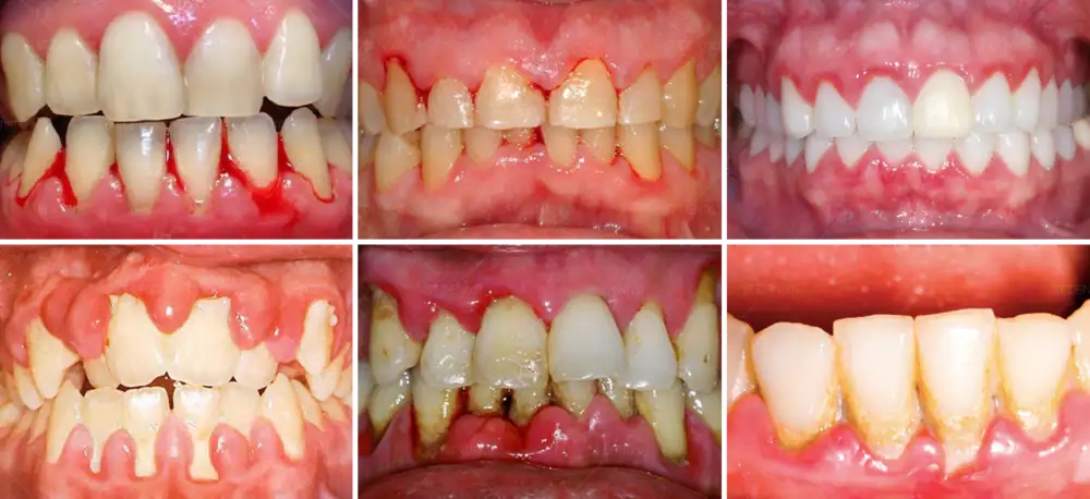Viêm Nướu Là Gì Dấu Hiệu, Nguyên Nhân Và Cách Điều Trị (1)